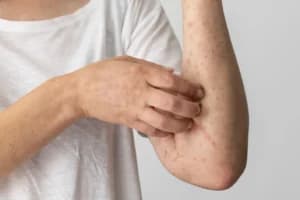 Jangan Abai, Campak Memicu Komplikasi Pneumonia hingga Kematian