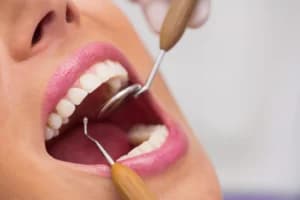 Apa Itu White Spot pada Gigi? Bercak Putih yang Bisa Jadi Tanda Awal Gigi Berlubang