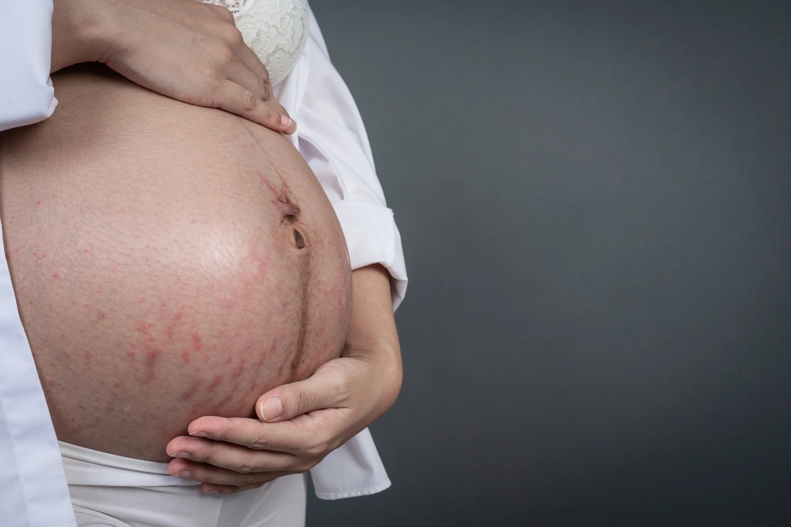 Ilustrasi stretch mark Ilustrasi stretch mark